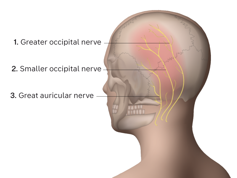 Illustration: anatomical position of occipital nerve and great auricular nerve